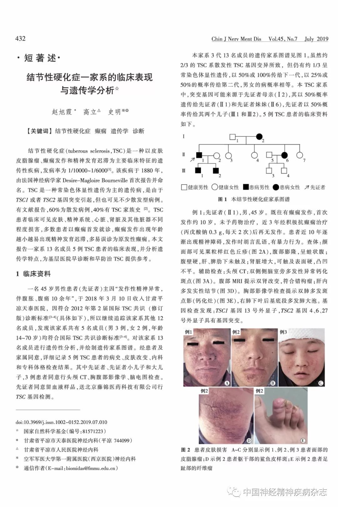 结节性硬化症最新研究突破与进展概述